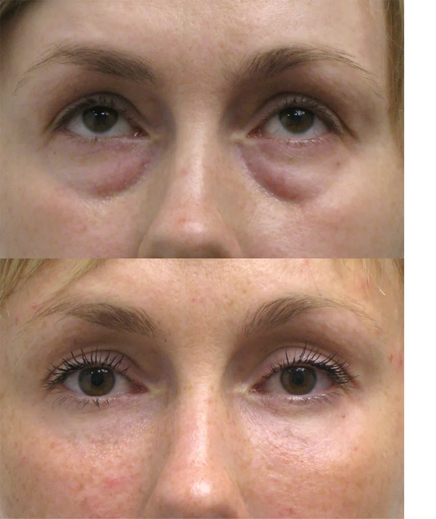 Mega Sale LOVILDS⢠Therapeutic eye spray đ| Doctor-Recommendedâ
| Safe and Effective 25 17411541133896