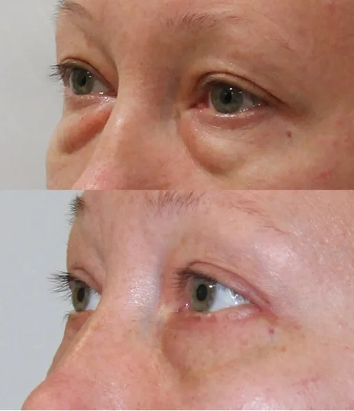 Mega Sale LOVILDS⢠Therapeutic eye spray đ| Doctor-Recommendedâ
| Safe and Effective 24 17411541818264