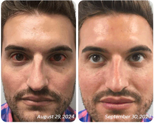 Mega Sale LOVILDS⢠Therapeutic eye spray đ| Doctor-Recommendedâ
| Safe and Effective 23 6 0d96f 1